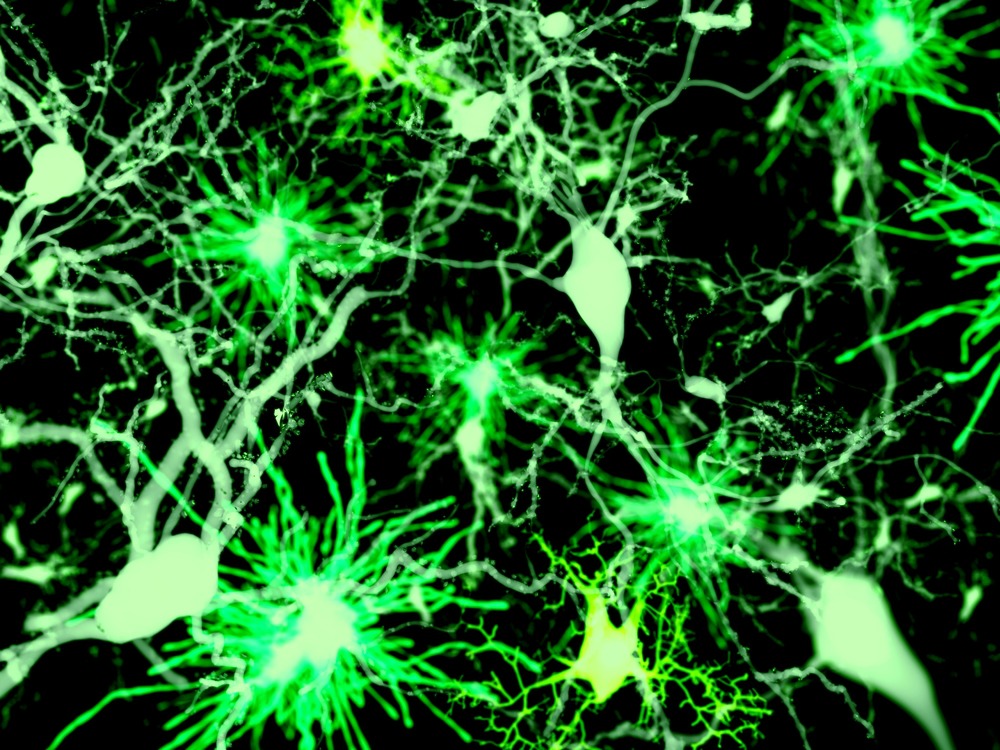 Új terápiás utat nyithat az agyi infarktus kezelésében magyar kutatók felfedezése