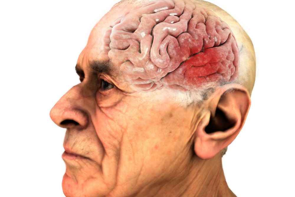 „Kiszagolható” lesz a Parkinson-kór?