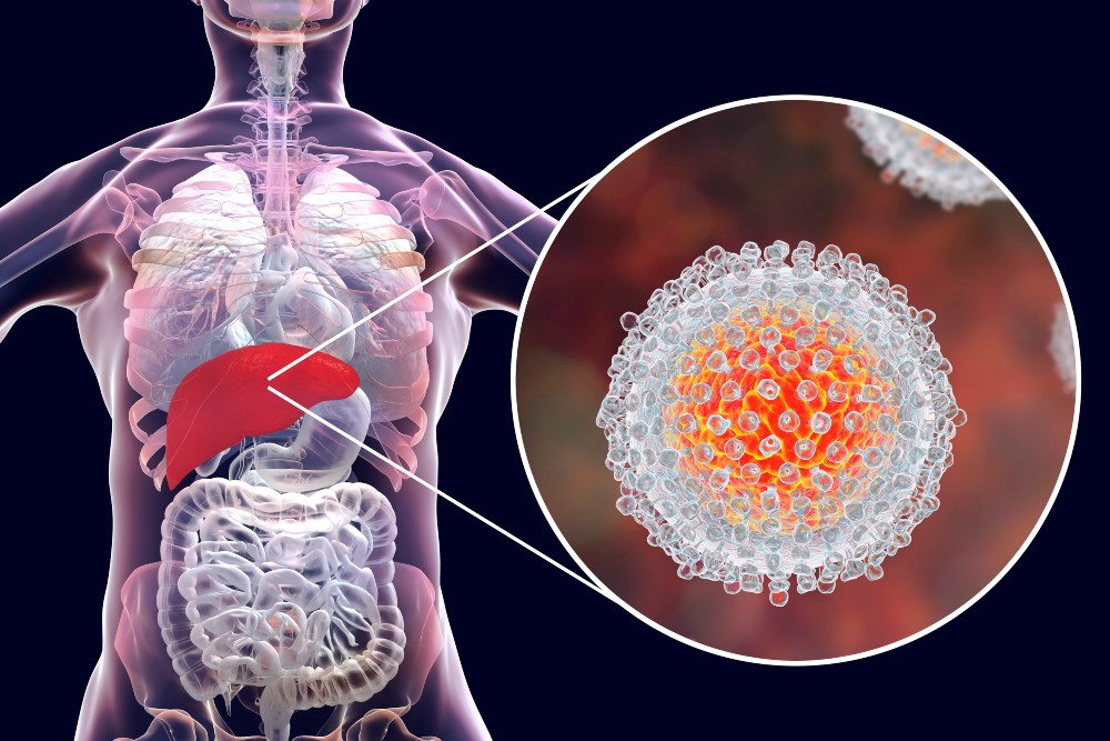 Ismét ingyenes hepatitis C-szűrés lesz