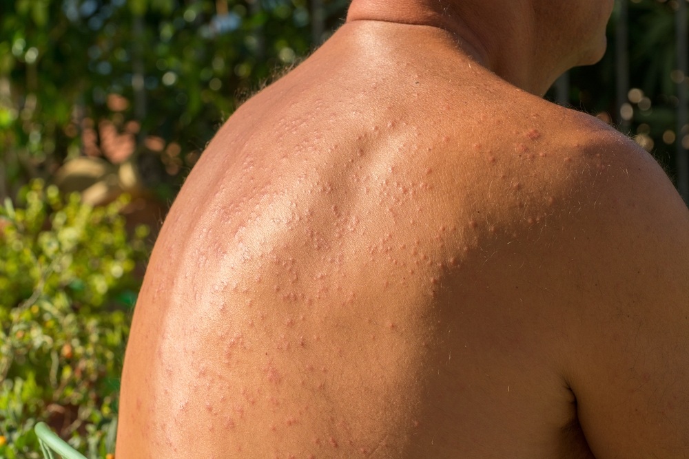 Hogyan kezelhető a napallergia?