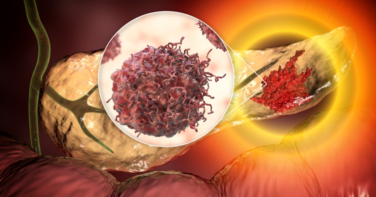 Boltban kapható immunterápia a hasnyálmirigyrák ellen?