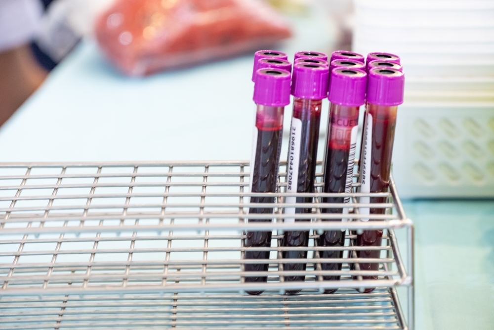 Ezek a laborértékek utalhatnak daganatos betegségre