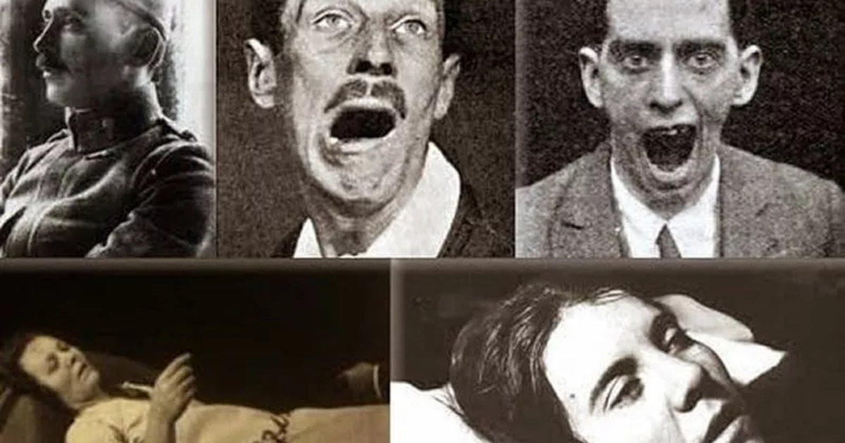 A járvány, amely élő testbe zárta az embereket + Videó!